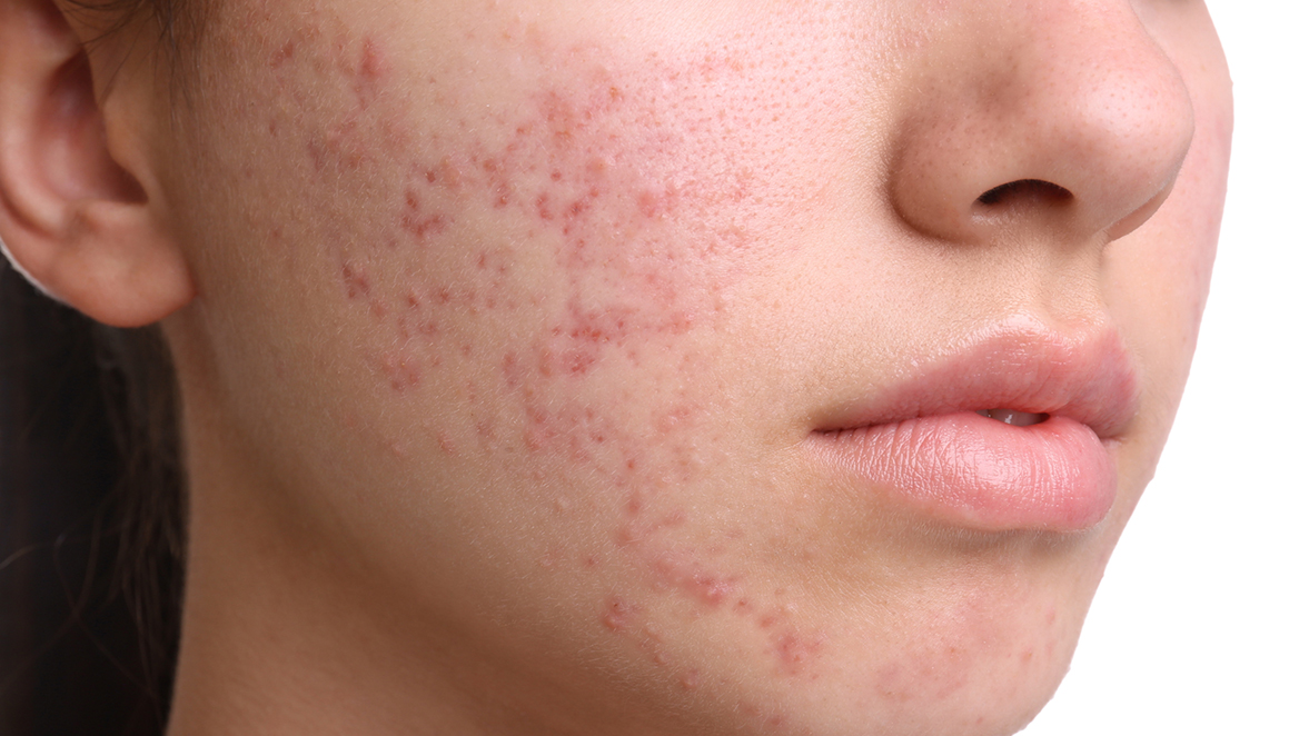 a woman's face with acne